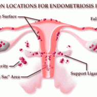 Endometriosis