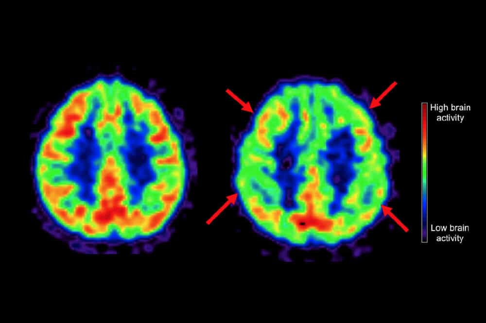 bran scan alzheimers mediterranean diet