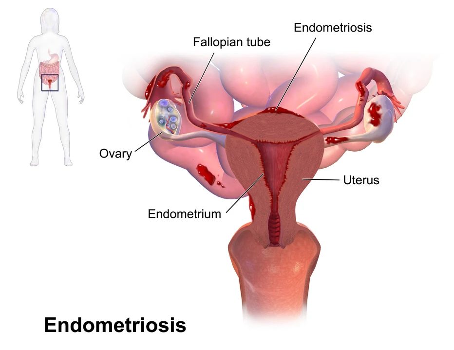 Drawing showing endometriosis