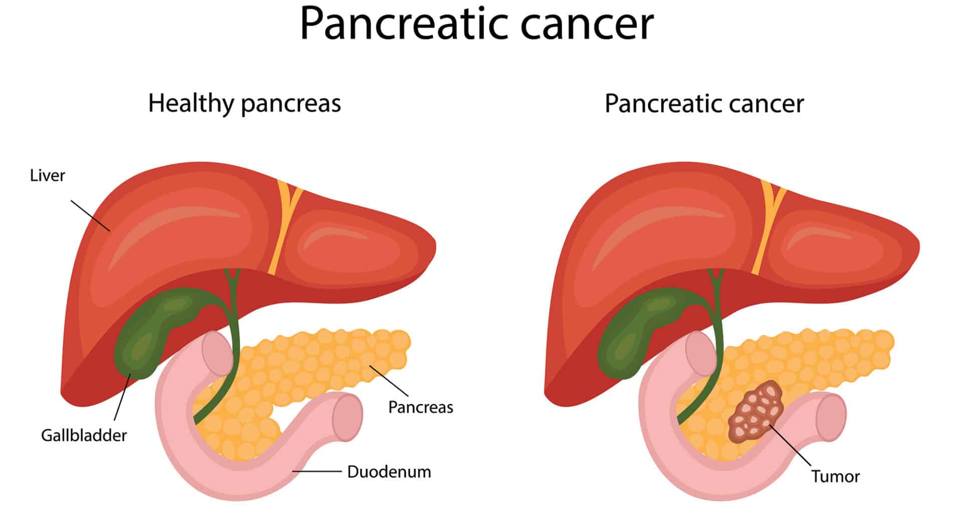 Pain Relief for Pancreatic Cancer: A Guide - Pain Resource