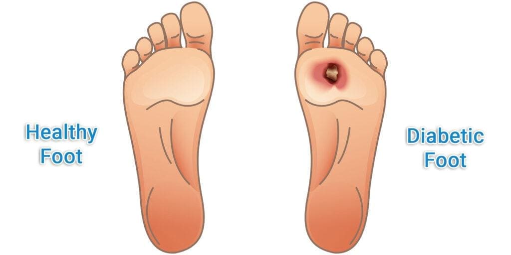 Symptoms of Diabetic Foot Pain