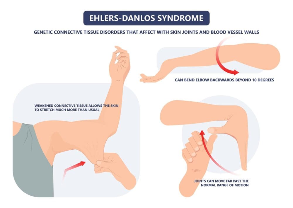 Ehlers-Danlos syndrome infographic