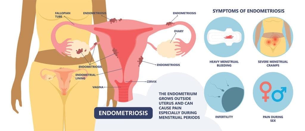 Causes An Endo Flare