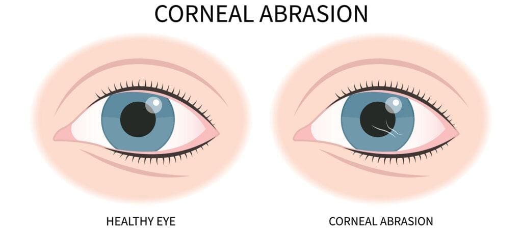 Corneal Abrasions
