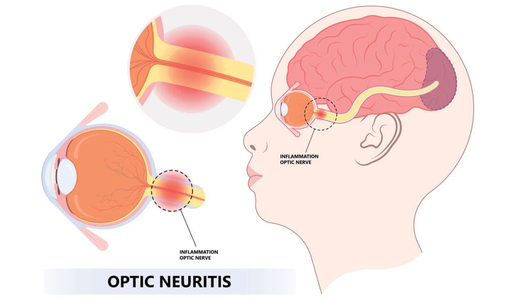 Optic Neuritis