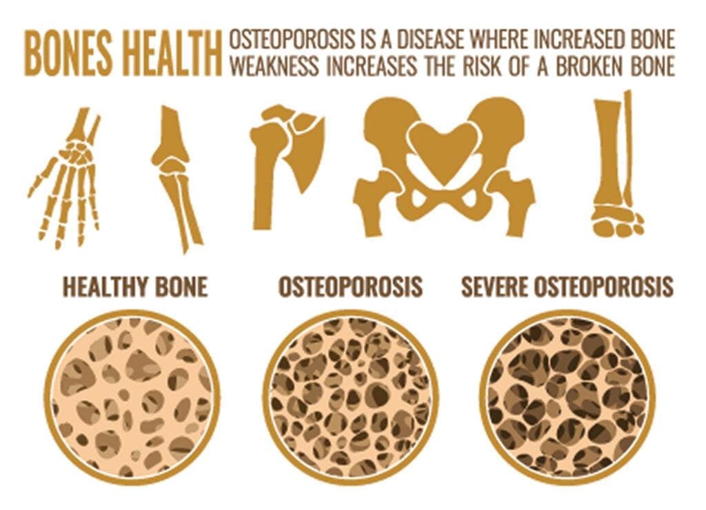 Bone Health