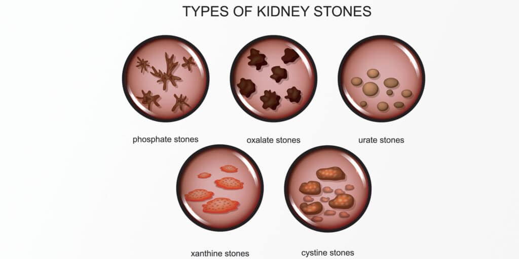 5 Dietary Kidney Stone Prevention Tips - Pain Resource