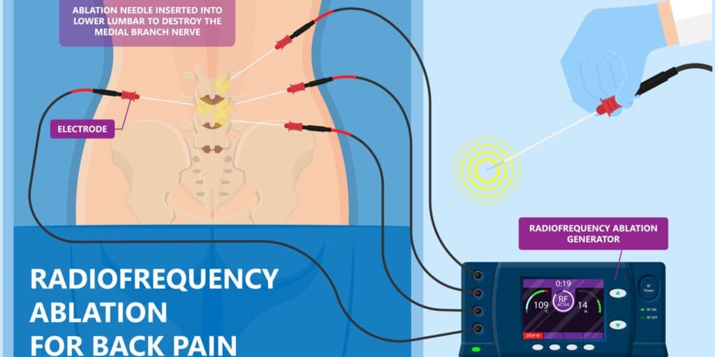 Radiofrequency Ablation for Back Pain