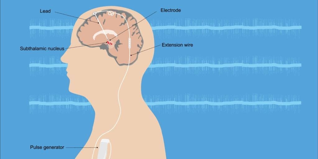 Deep Brain Stimulation