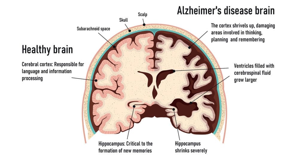 Alzheimer’s and the Brain