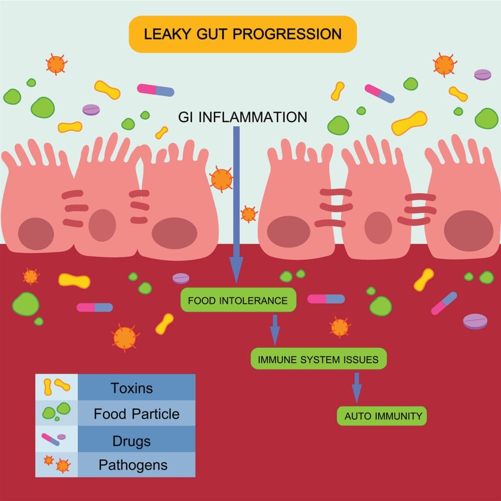 Causes of a leaky gut