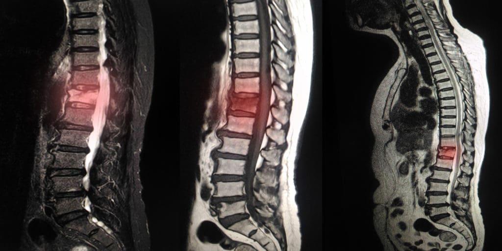 Disc-related Back Pain