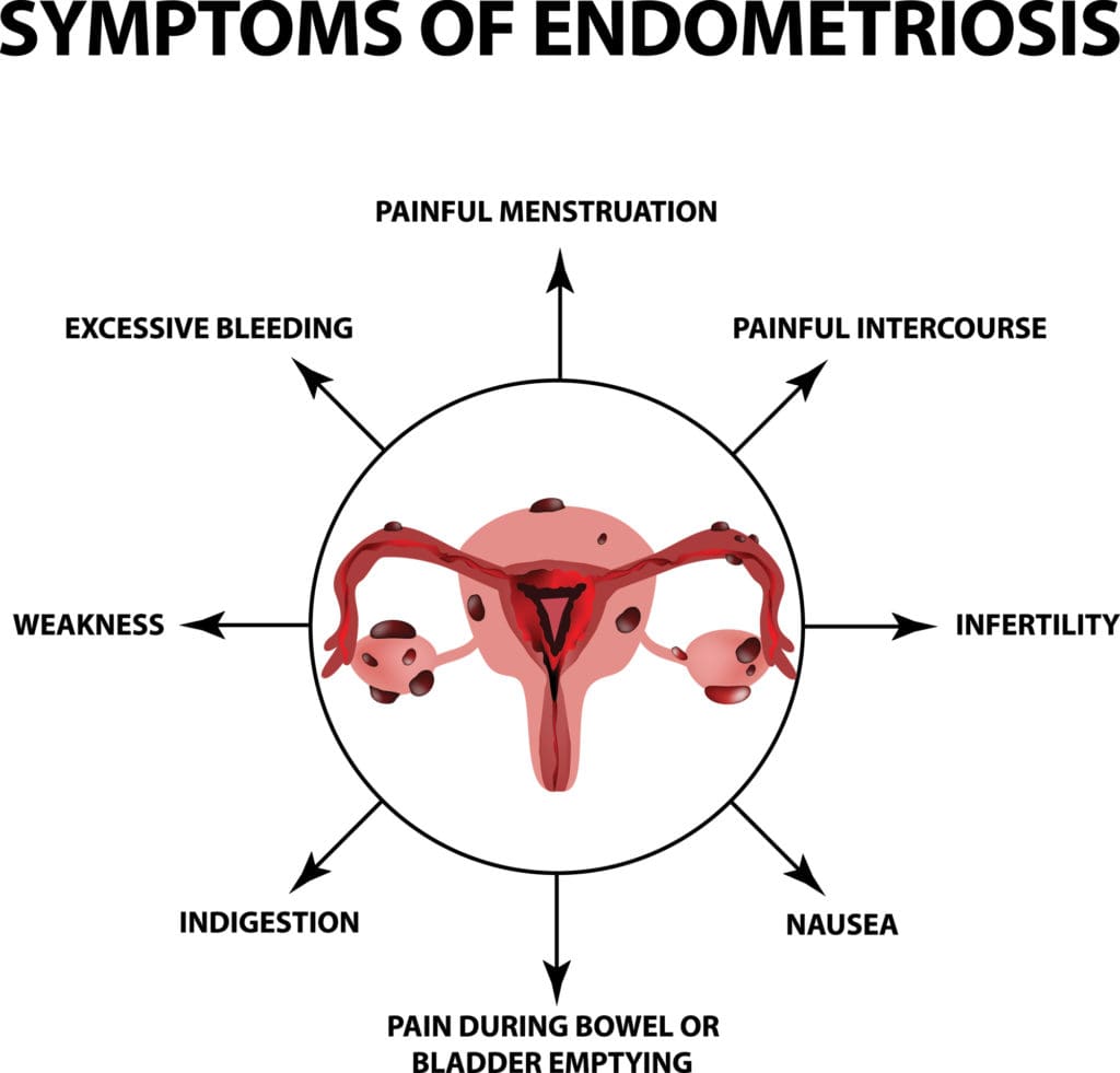 Painful Periods Endometriosis