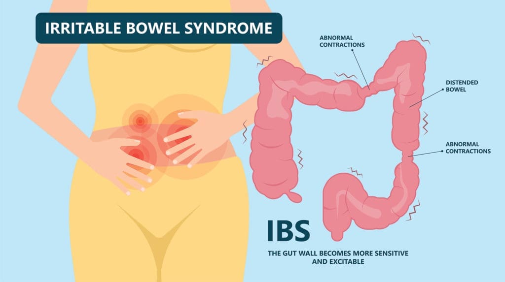 Irritable Bowel Syndrome