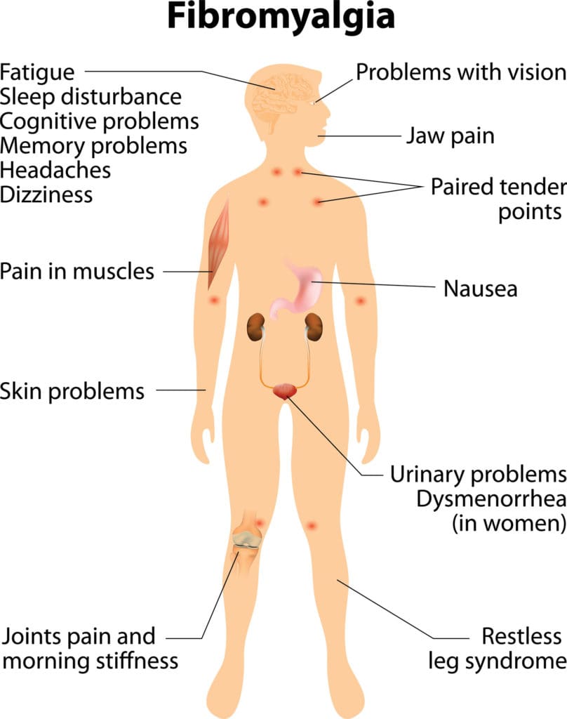 Signs of Fibromyalgia Infographic