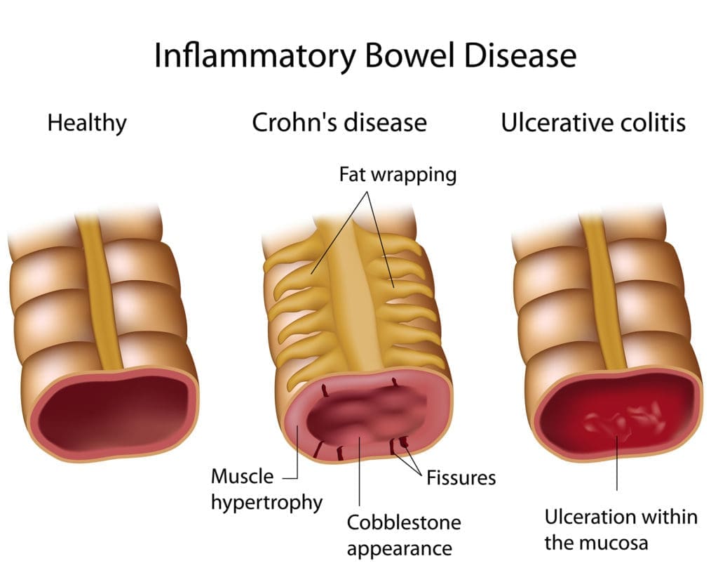 Understanding Crohn’s Disease Infographic