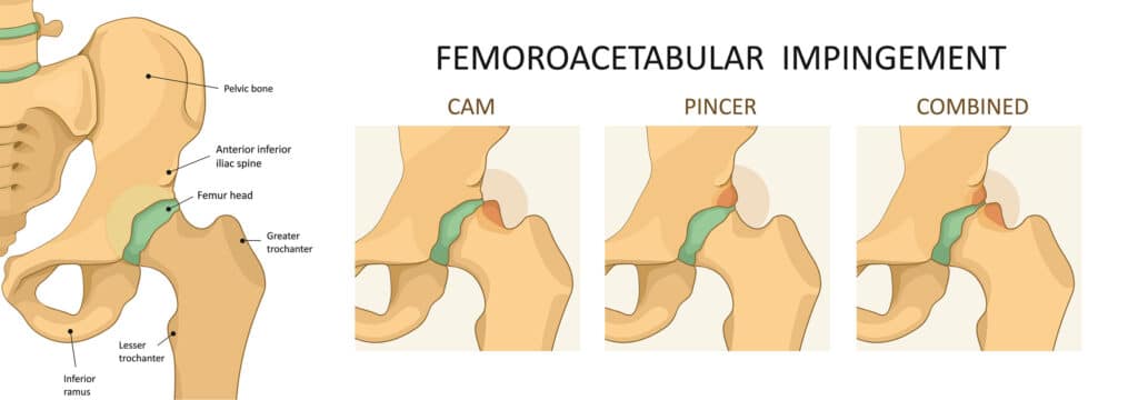 What Causes Hip Impingement?