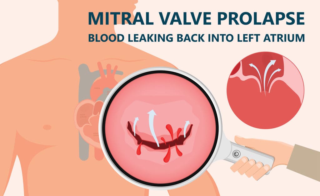 What Is Mitral Valve Prolapse?