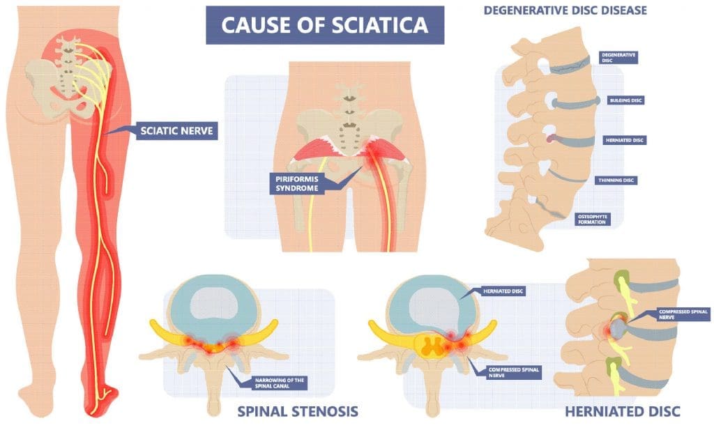 What Is Sciatica