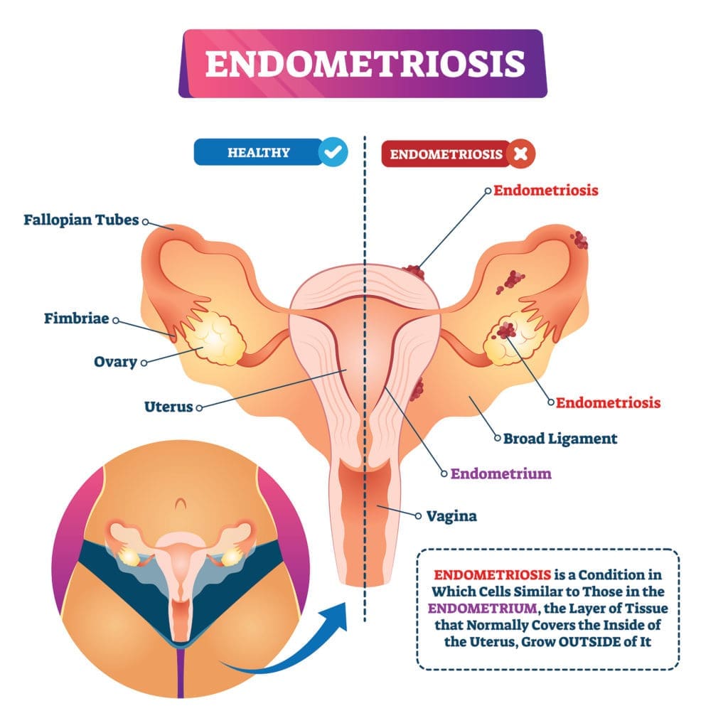 What is Endometriosis