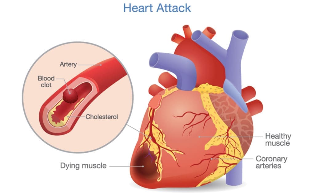 heart muscle damage