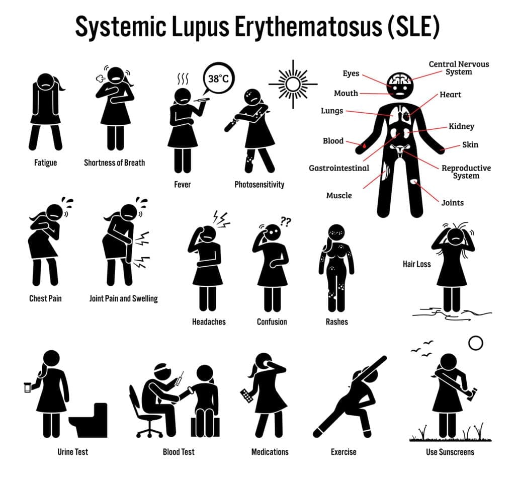 lupus erythematosus chart