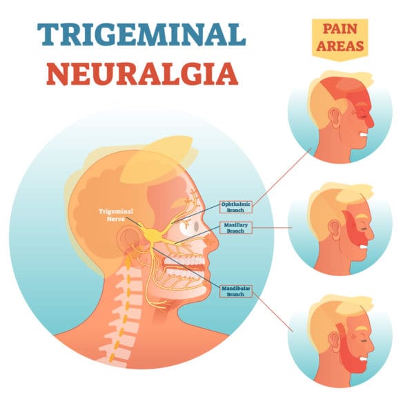 Infographic Trigeminal Neuralgia - the suicide disease TN pain areas