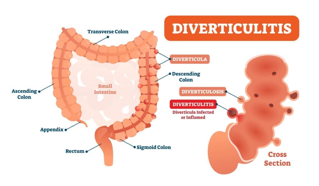 What is diverticulitis?