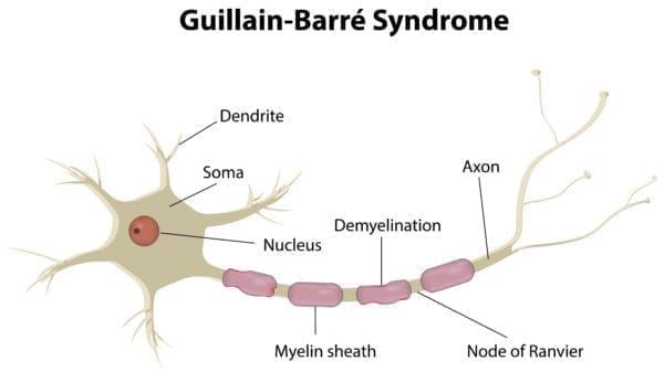 What is Guillain-Barre Syndrome