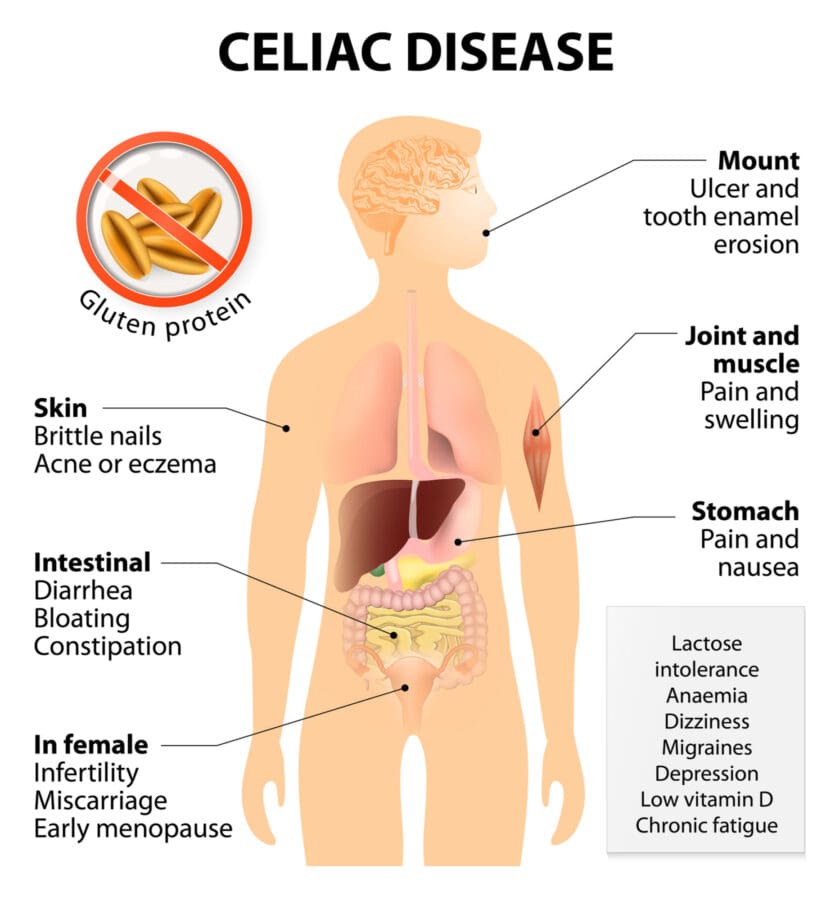 celiac disease infog