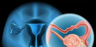 Ovarian Cancer and Back Pain