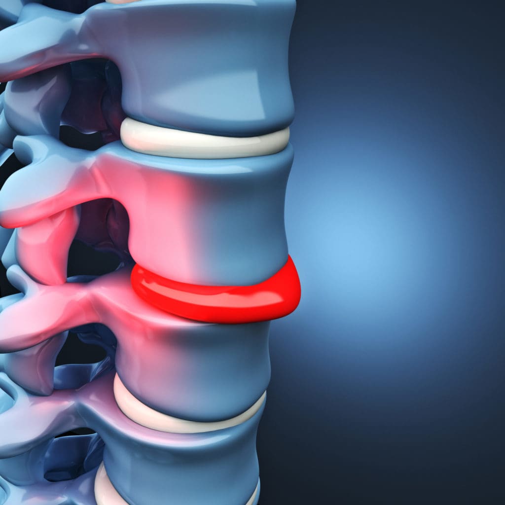Herniated Discs and the Cervical Spine