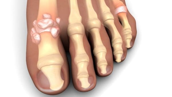 What is gout?