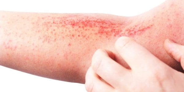 skin sensitive to touch with rash
